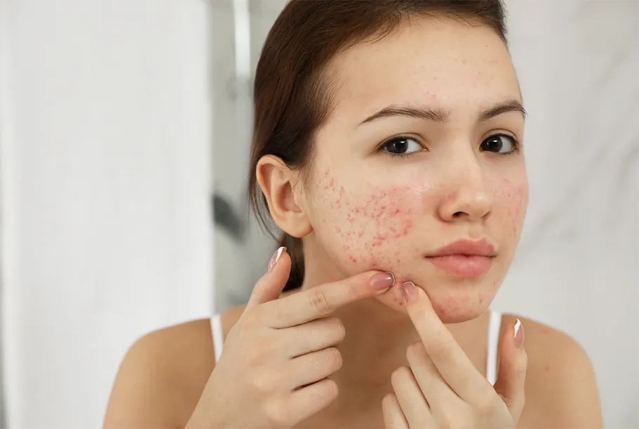Acne & Scars Removal