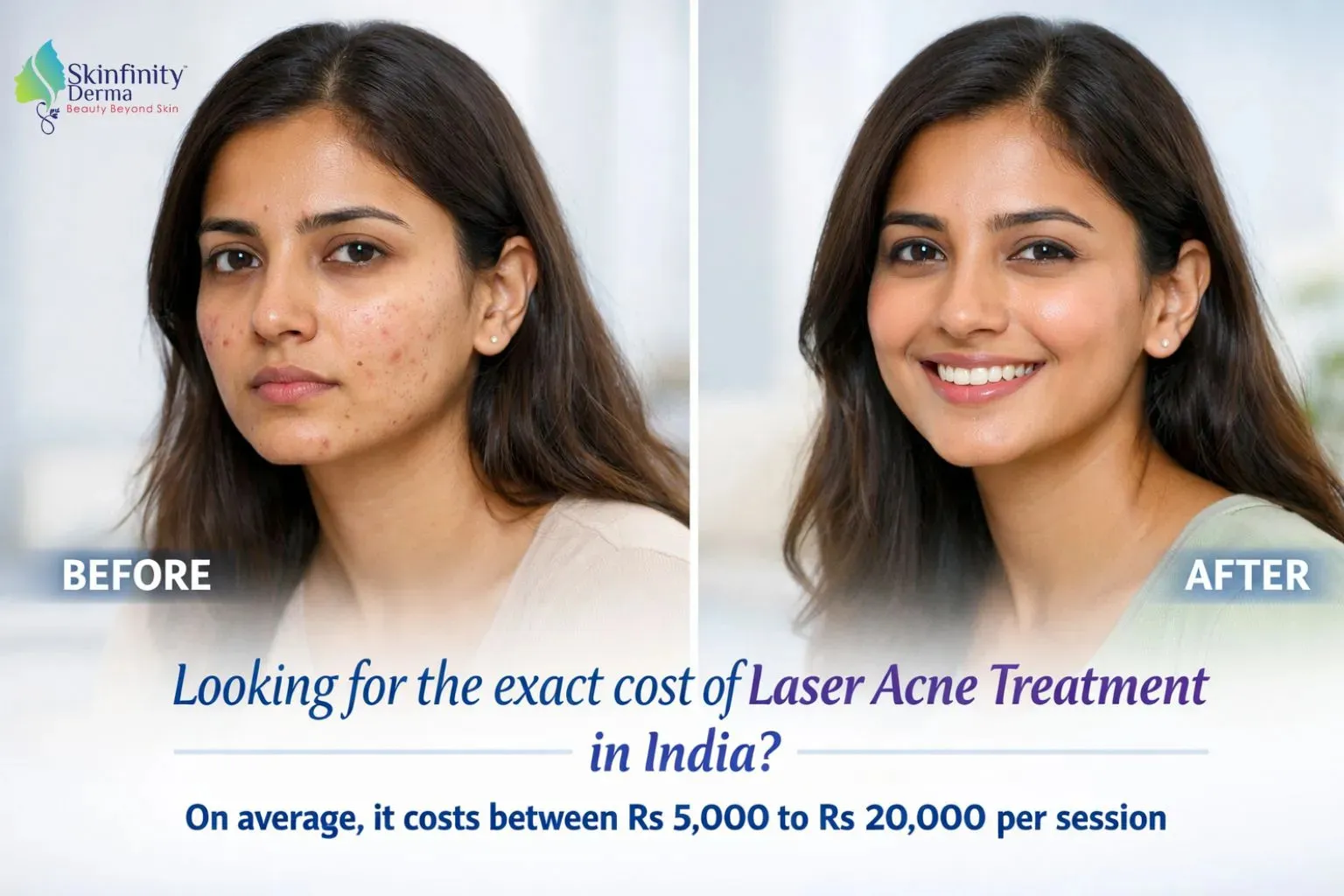 Laser Acne Scar Removal Cost India Price Guide