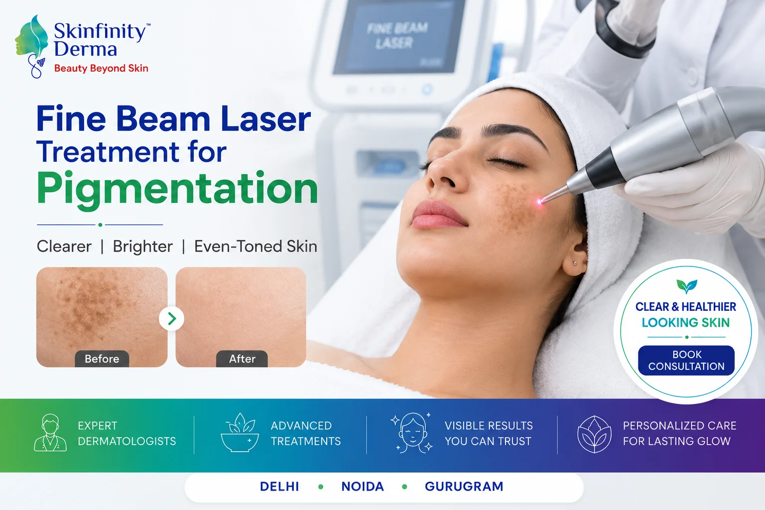 Fine Beam Laser Treatment for Pigmentation